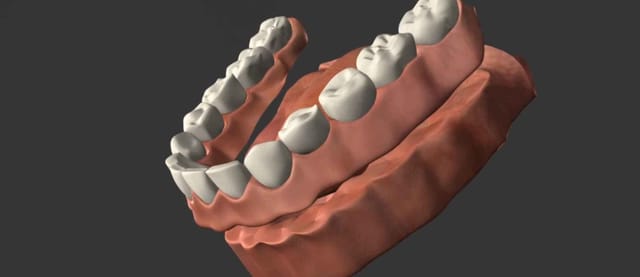 Dentures Dentures