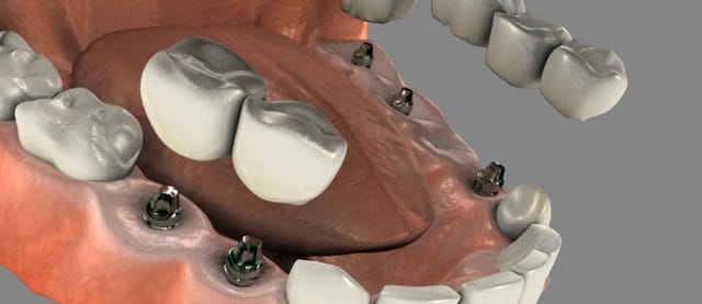 Dental Implants