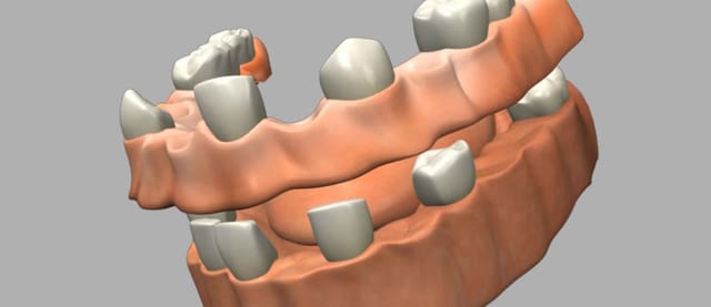 Dentures Dentures